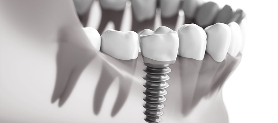 Dental Implants