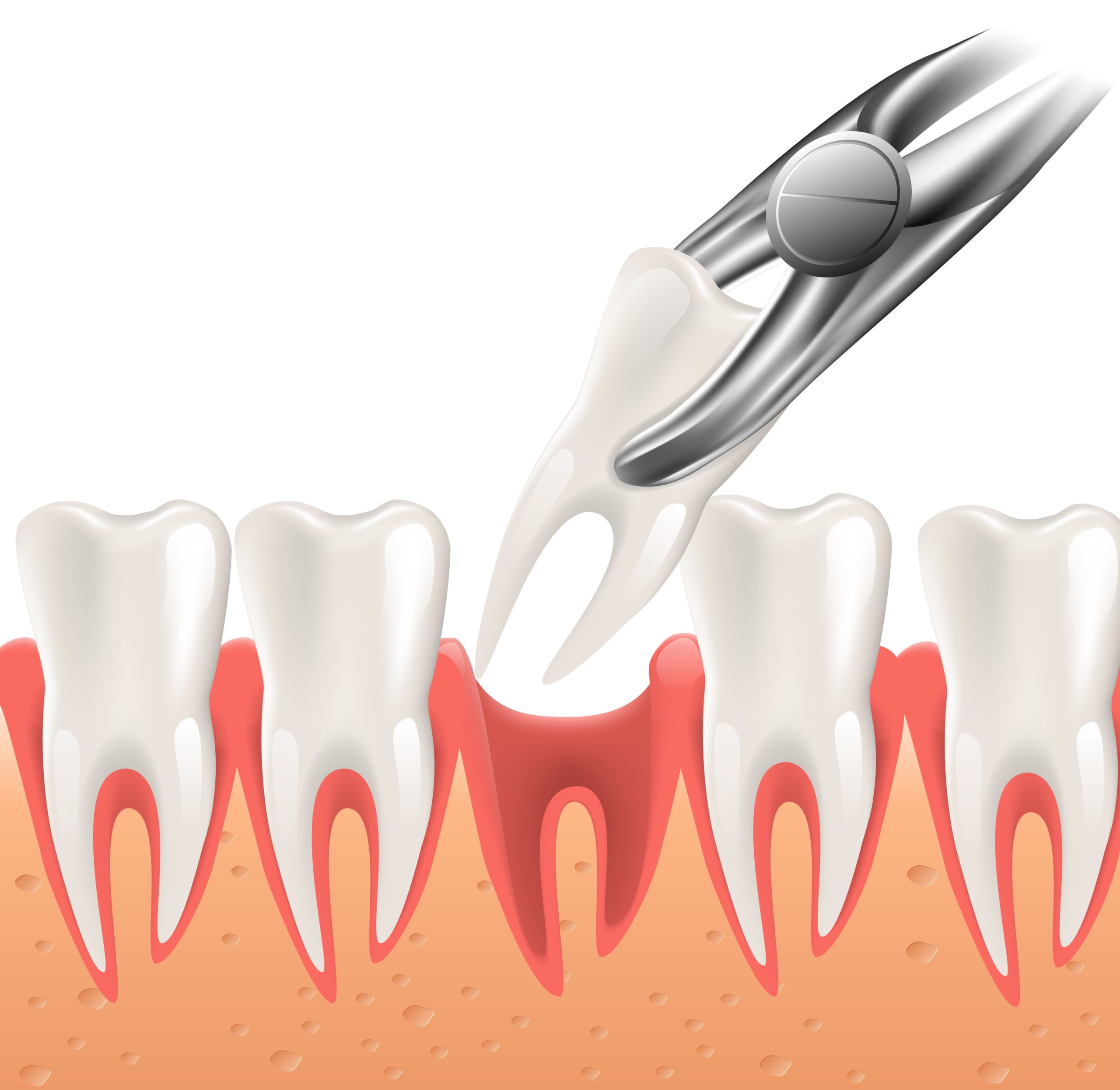 Signs That You Need a Tooth Extraction