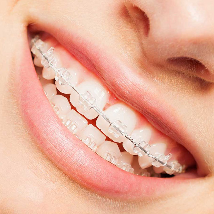 Clear Braces