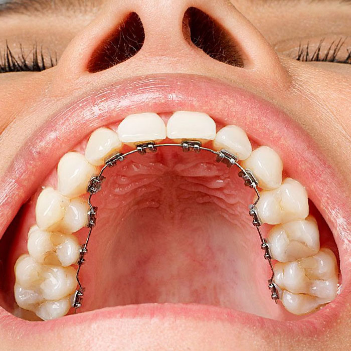 Lingual Braces