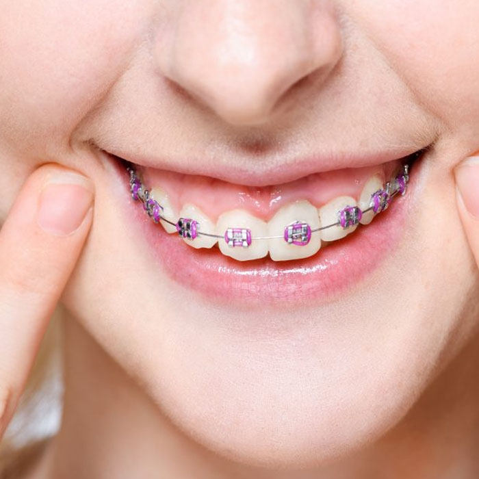 Metal Braces