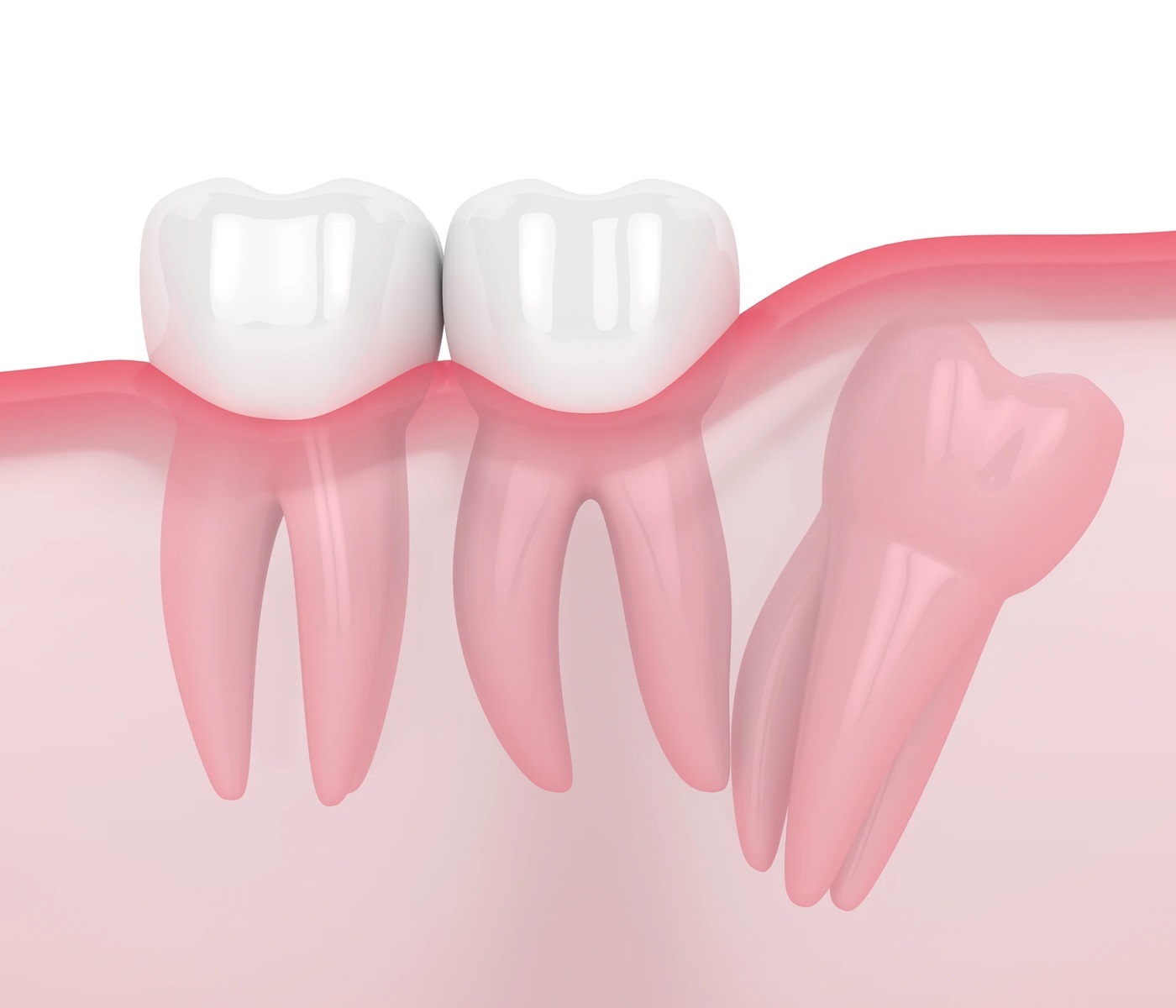 Distal Impaction