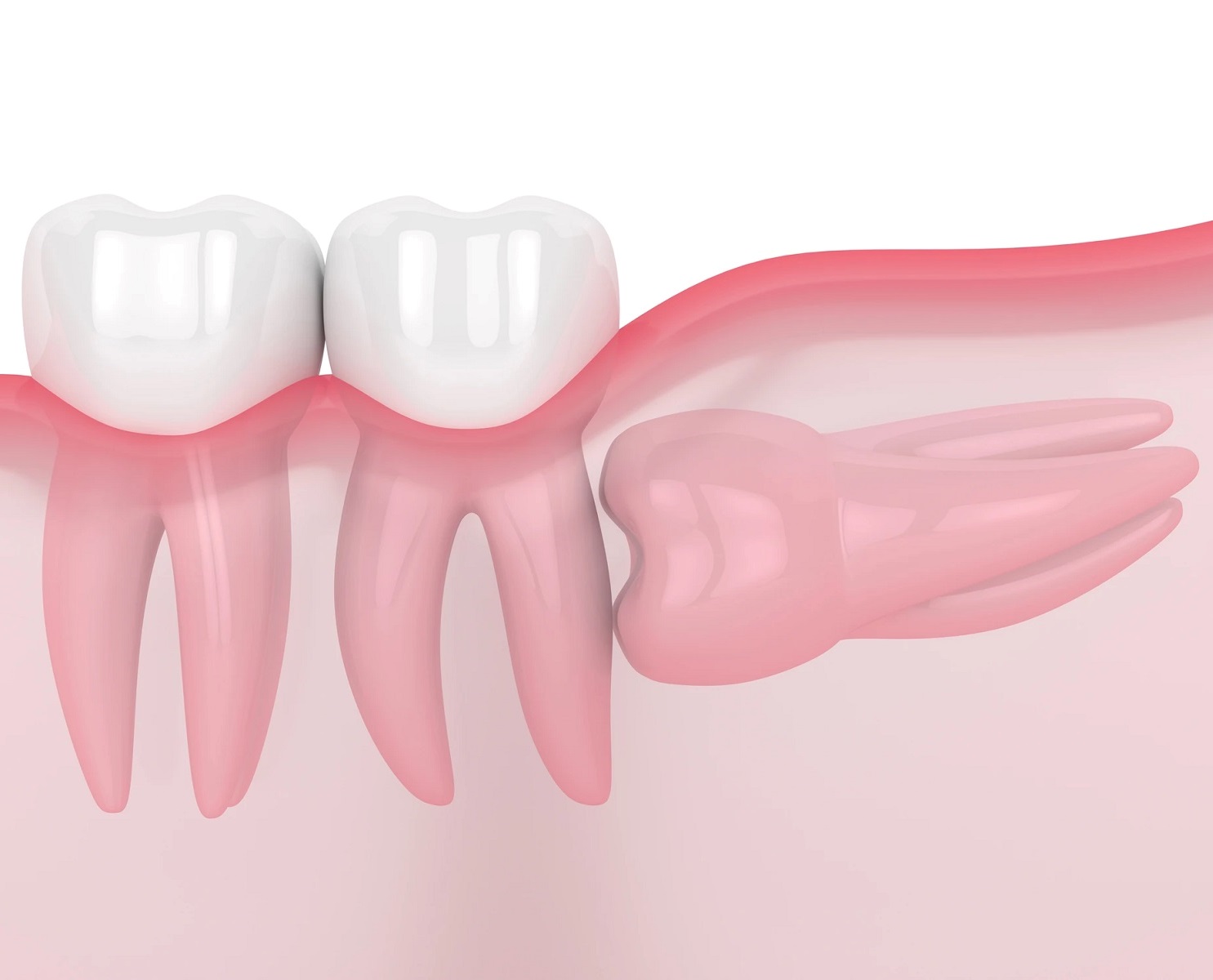 Horizontal Iimpaction
