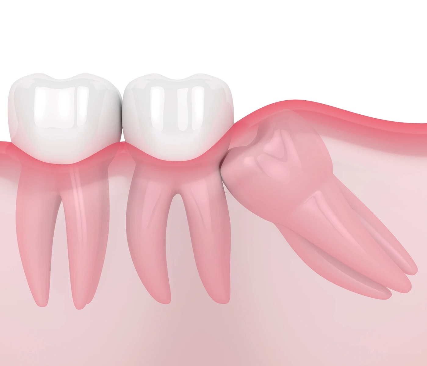 Mesial Impaction