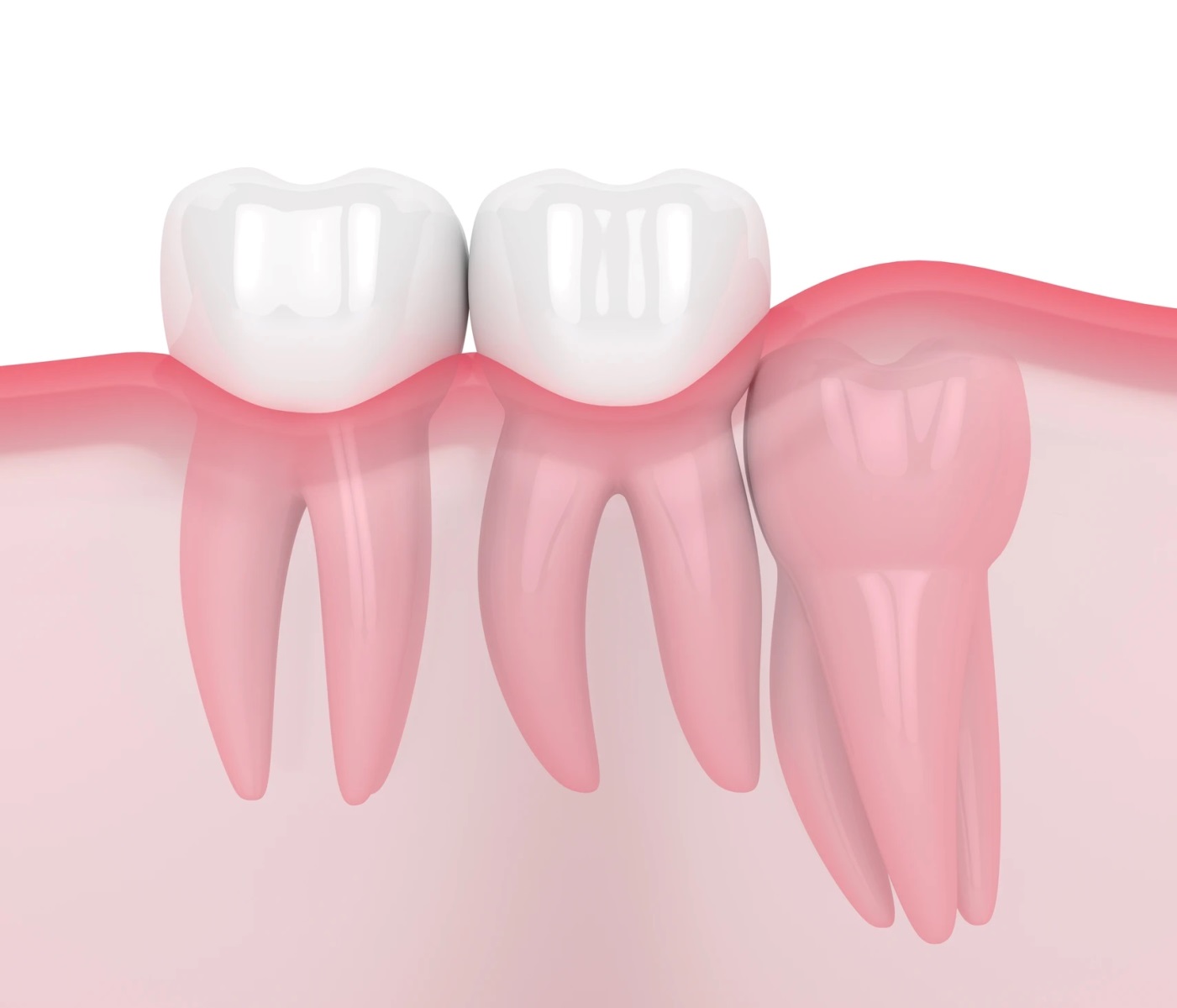 Vertical Impaction